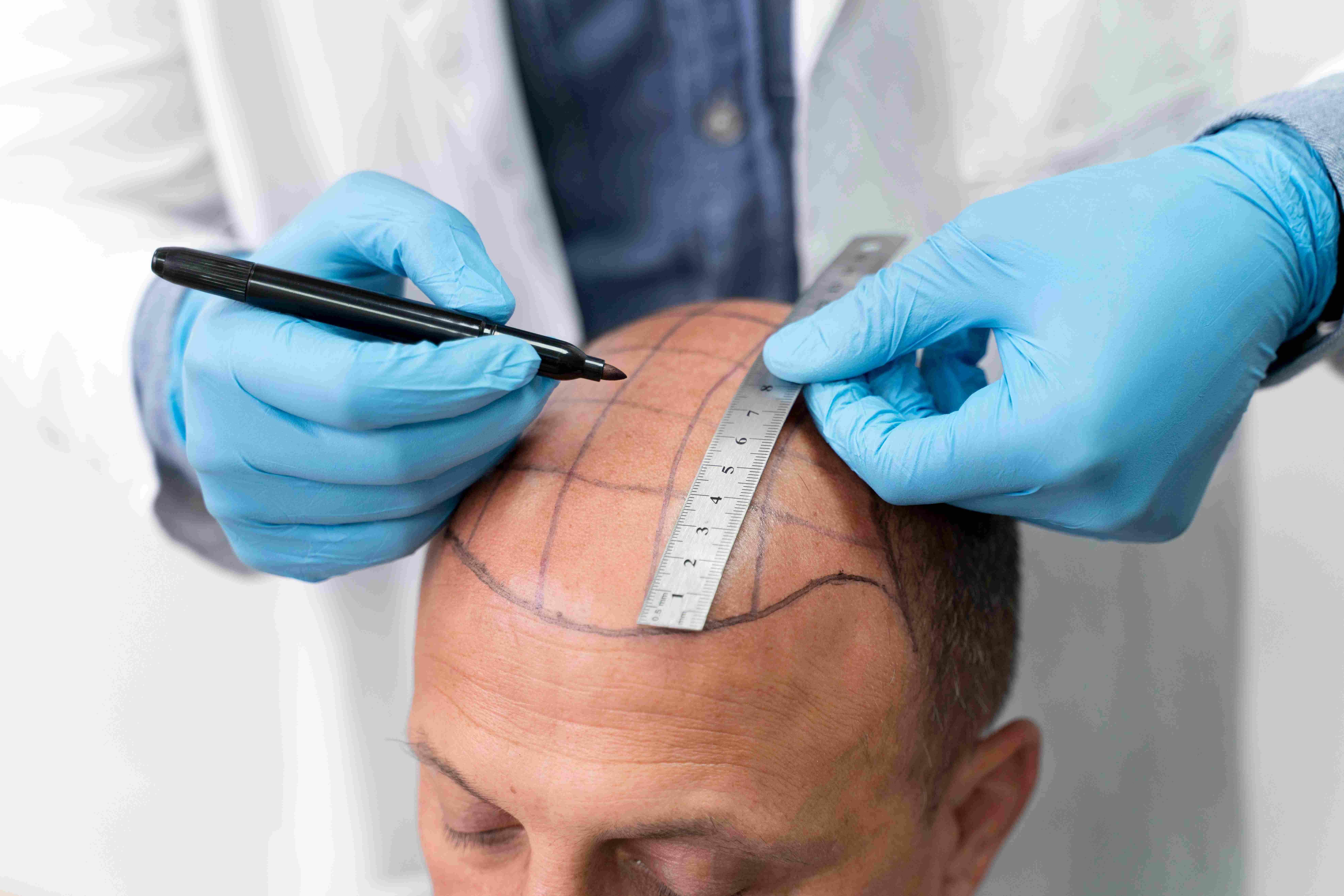 hair transplant clinic in calicut